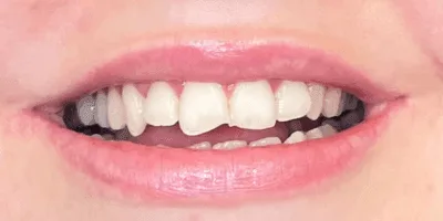 Crooked teeth
