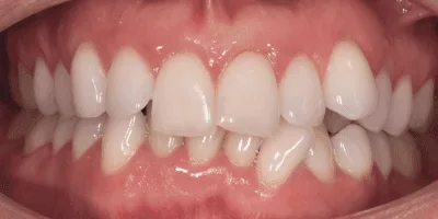 Crooked teeth