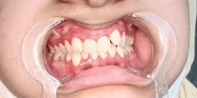 Dental treatment