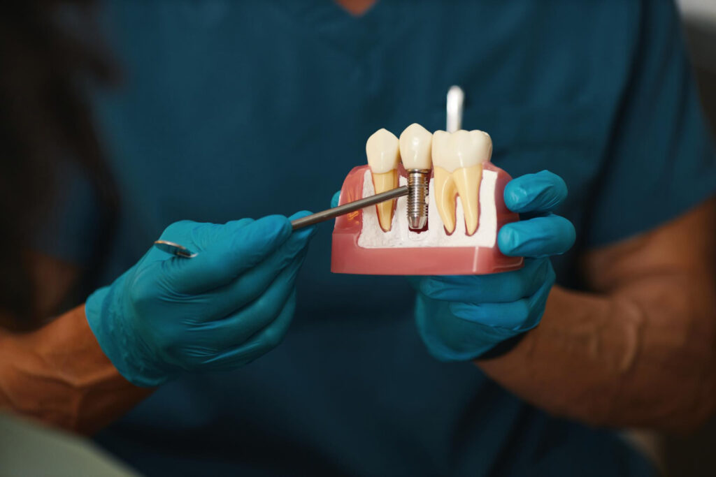 Image of a dentist holding dental implants