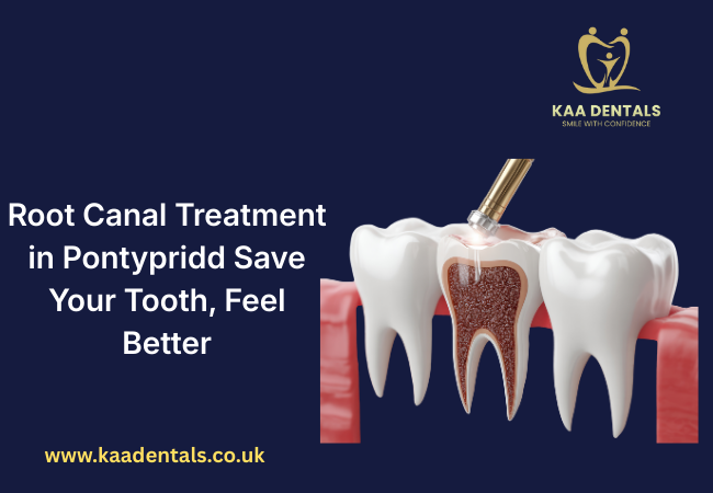 Root canal treatment in Pontypridd showing infected tooth being cleaned
