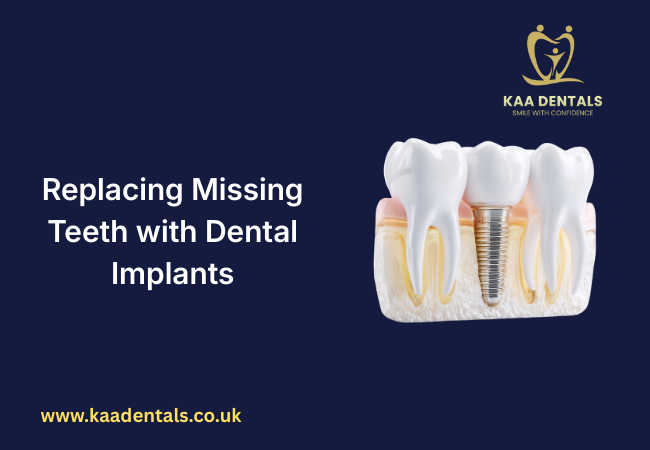 Dental Implants in Pontypridd: Cost, Types, Benefits & How Long They Last