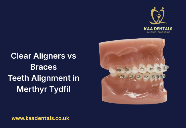 clear aligners vs braces teeth alignment treatment in Merthyr Tydfil for adults