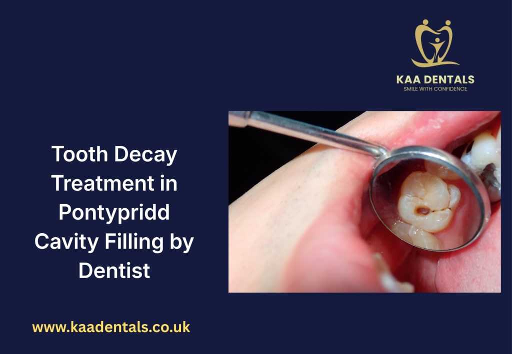 Tooth decay treatment in Pontypridd dentist placing cavity filling to repair a damaged tooth