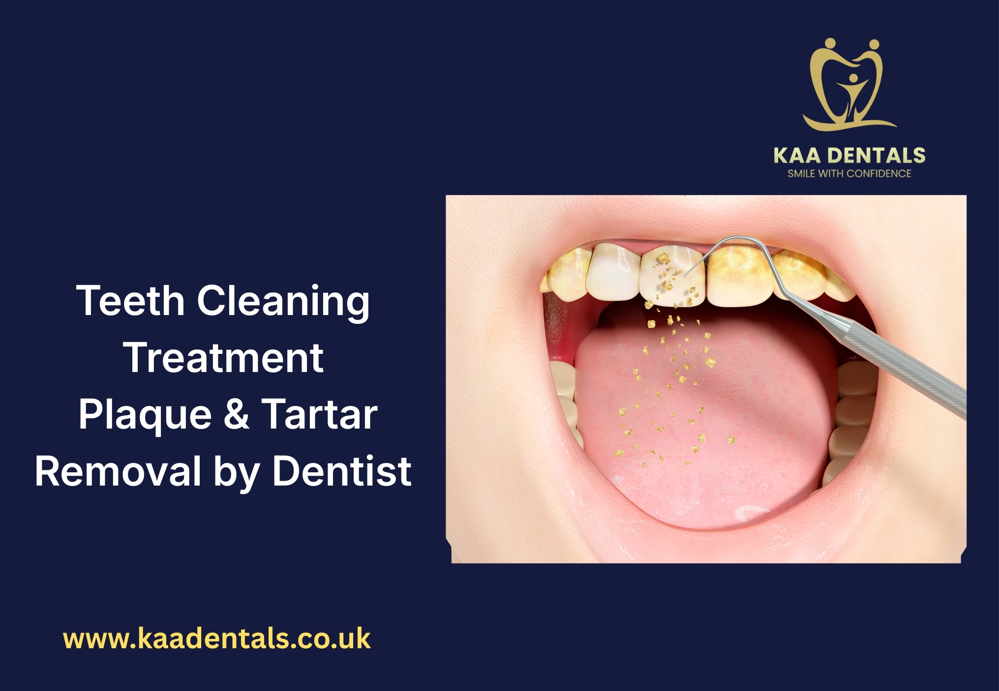 Plaque and Tartar Removal in Pontypridd Dentist Teeth Cleaning Treatment