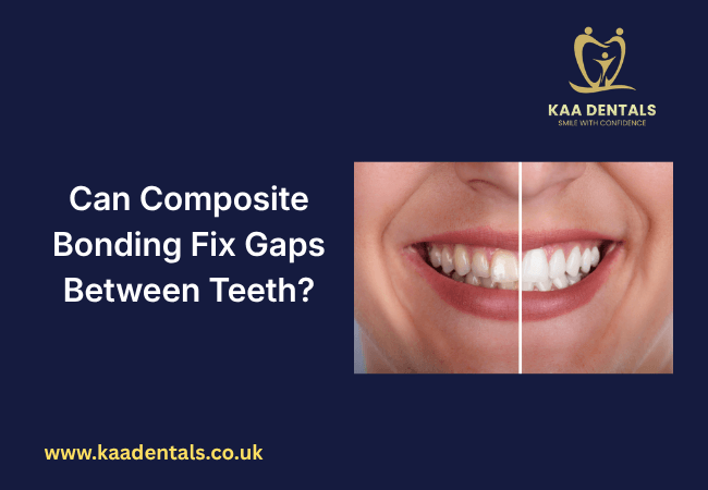 teeth composite bonding