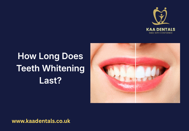 How Long Does Teeth Whitening Last? Complete Guide