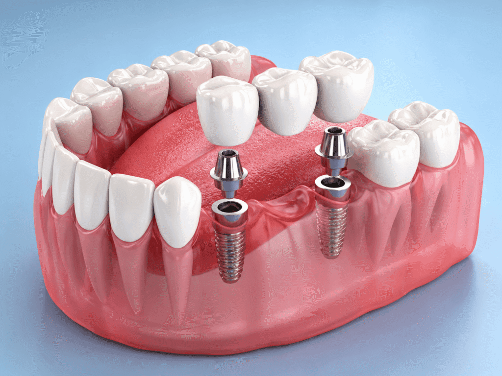 Multiple Teeth & All-on-4/6 Dental Implants