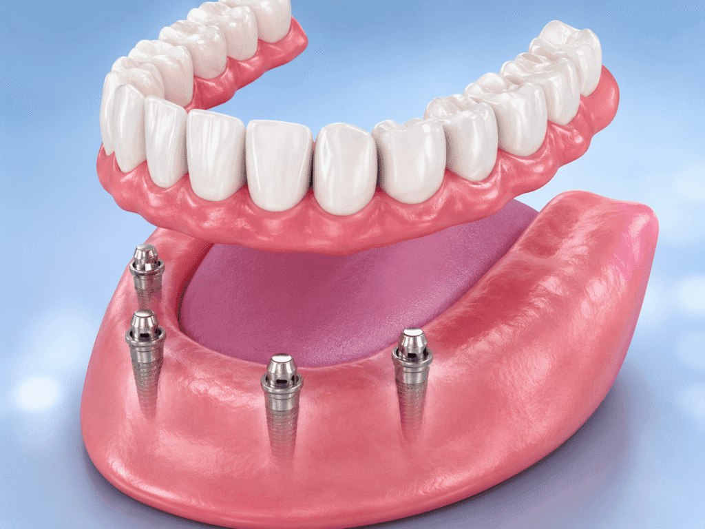 Implant-Supported Dentures