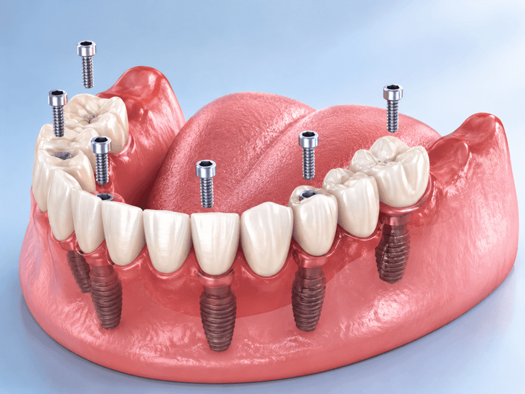 Full Mouth Dental Implants