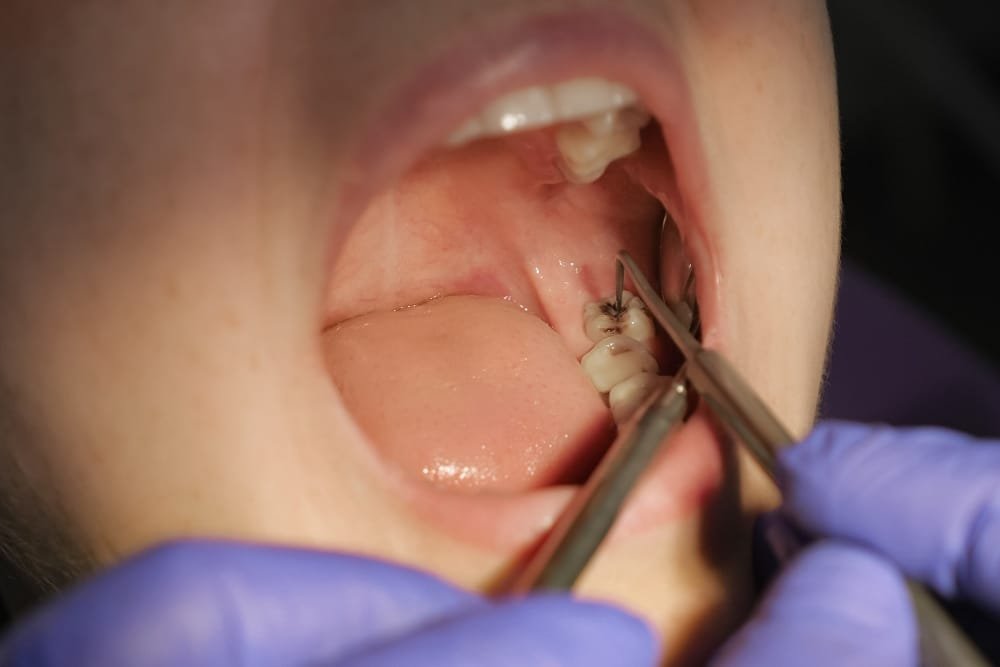 dental filling