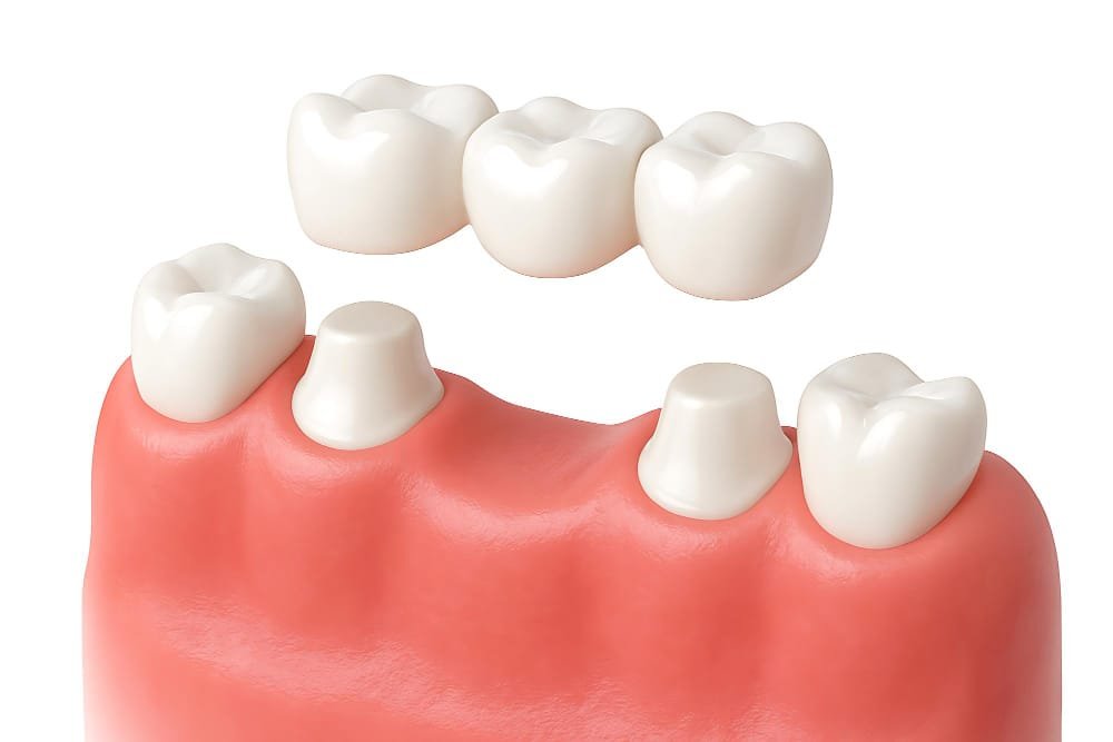 dental bridge