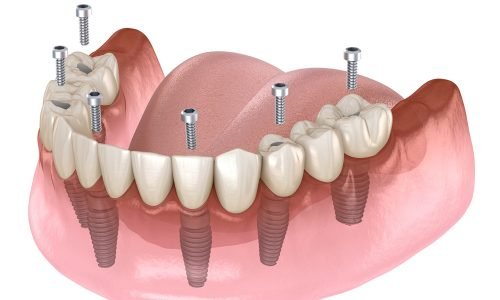 All-on-4-Full-Mouth-Implants.jpg