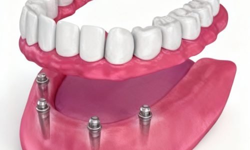 Implants-supported-dentures.jpeg