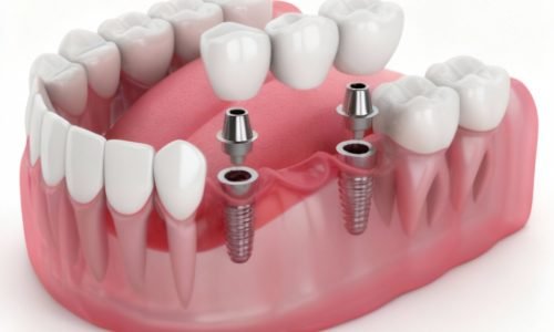 Multiple-Tooth-Implants-Implant-Bridge.jpeg